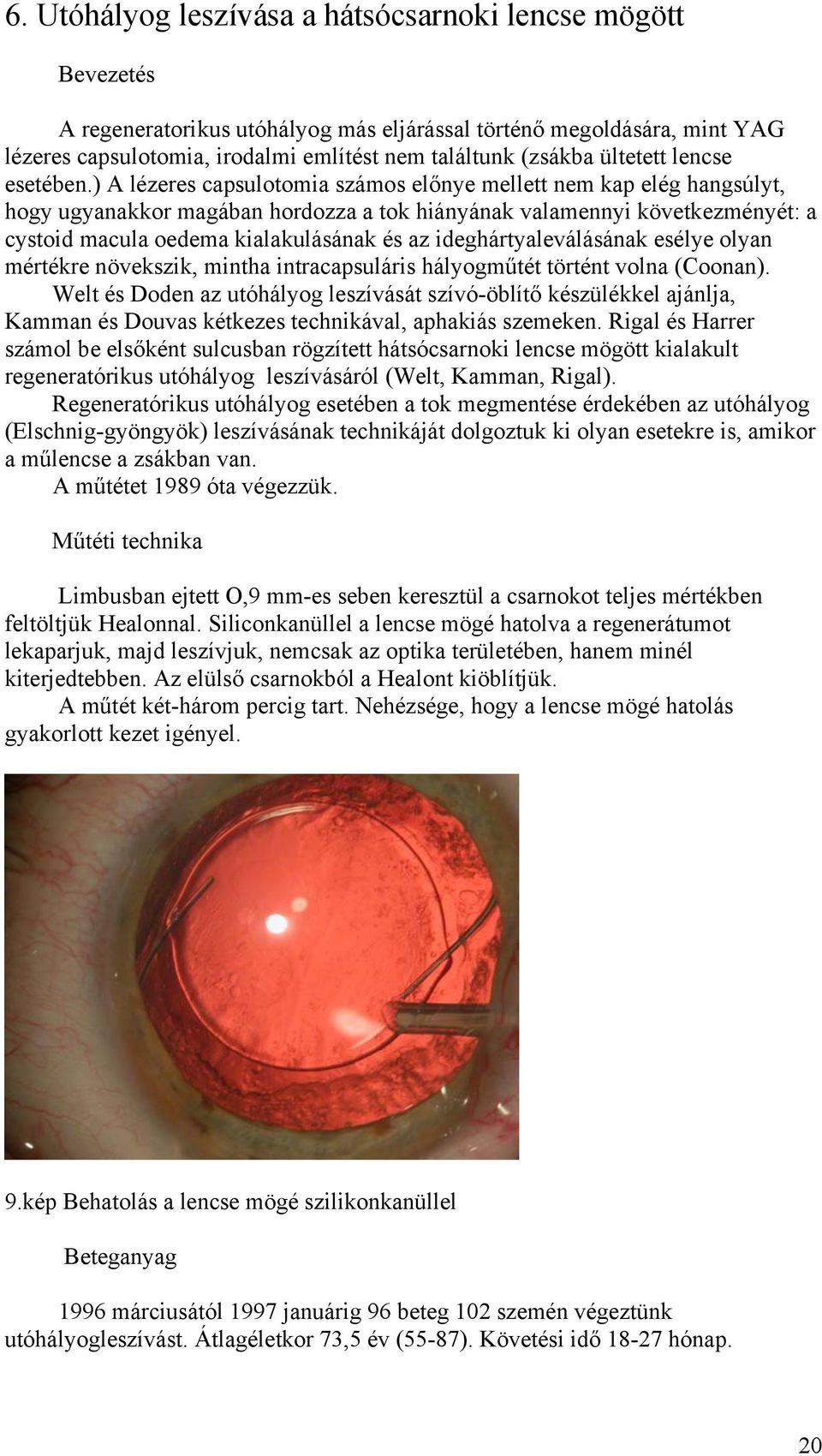 ) A lézeres capsulotomia számos el nye mellett nem kap elég hangsúlyt, hogy ugyanakkor magában hordozza a tok hiányának valamennyi következményét: a cystoid macula oedema kialakulásának és az