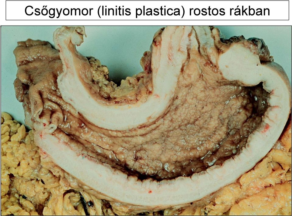 (linitis