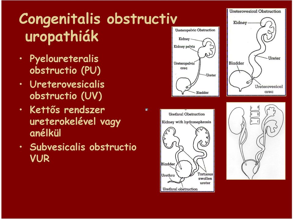 Ureterovesicalis obstructio (UV) Kettıs