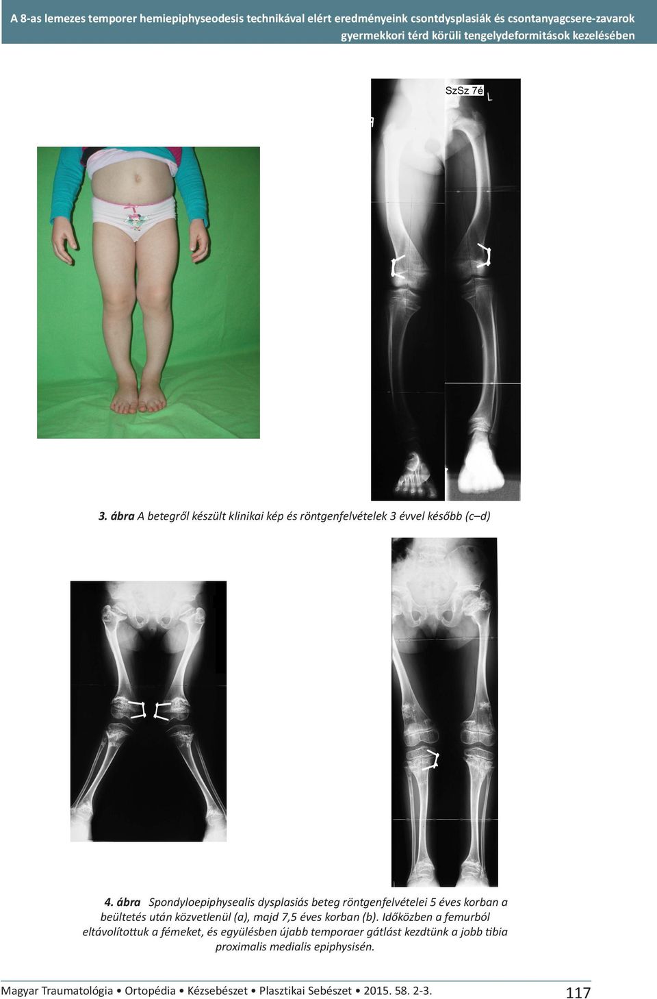 ábra Spondyloepiphysealis dysplasiás beteg röntgenfelvételei 5 éves korban a beültetés után közvetlenül (a), majd 7,5 éves korban (b).