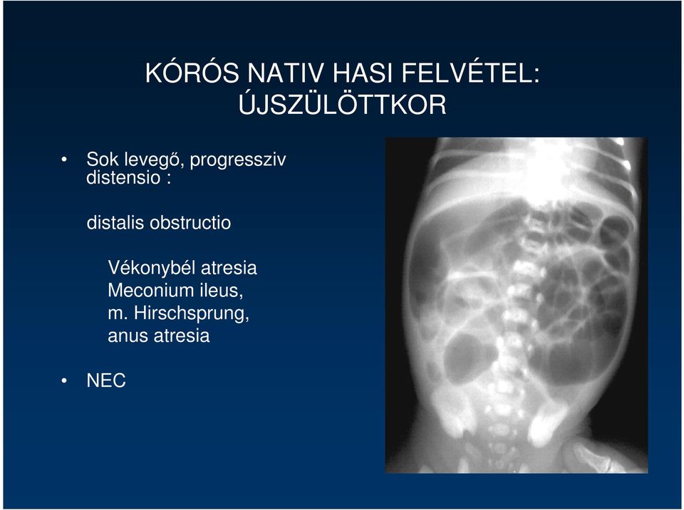 distalis obstructio NEC Vékonybél