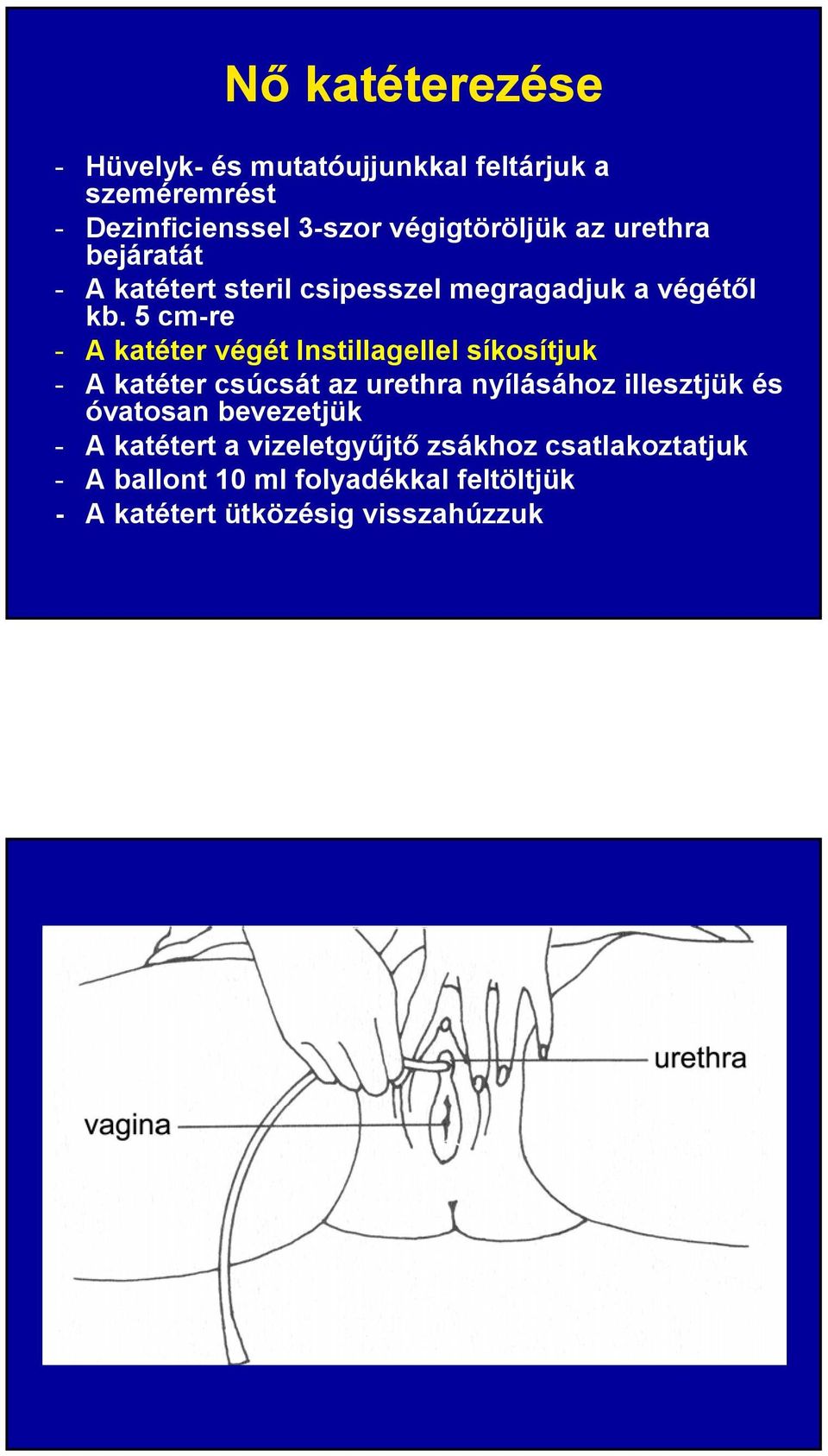 5 cm-re - A katéter végét Instillagellel síkosítjuk - A katéter csúcsát az urethra nyílásához illesztjük és