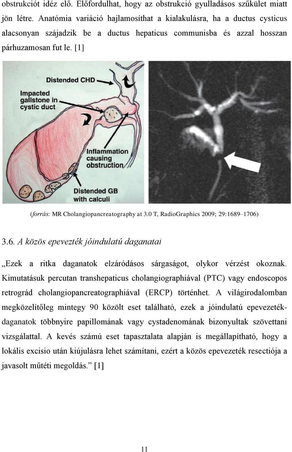 [1] (forrás: MR Cholangiopancreatography at 3.0 T, RadioGraphics 2009; 29:1689 1706) 3.6. A közös epevezték jóindulatú daganatai Ezek a ritka daganatok elzáródásos sárgaságot, olykor vérzést okoznak.