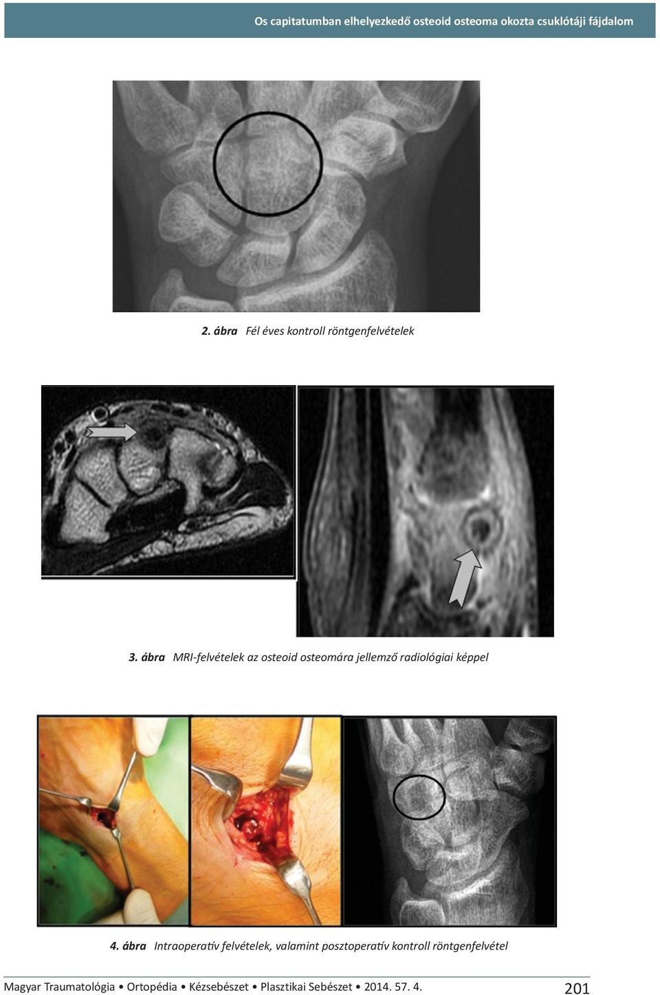 ábra MRI-felvételek az osteoid osteomára jellemző radiológiai képpel 4.