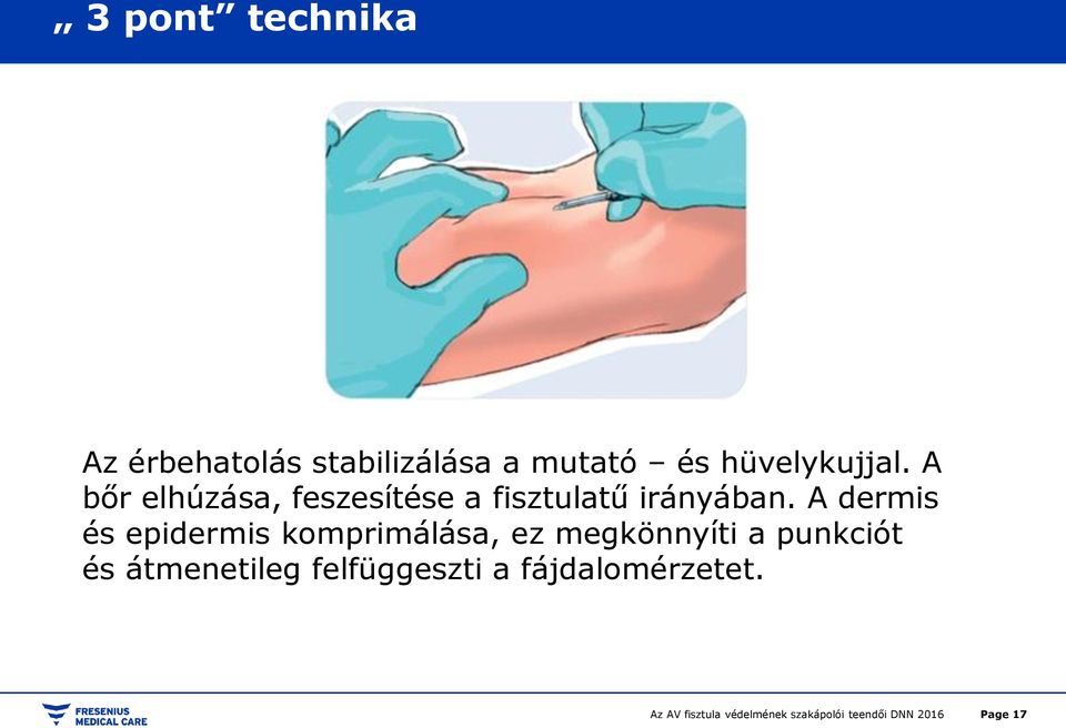 A bőr elhúzása, feszesítése a fisztulatű irányában.