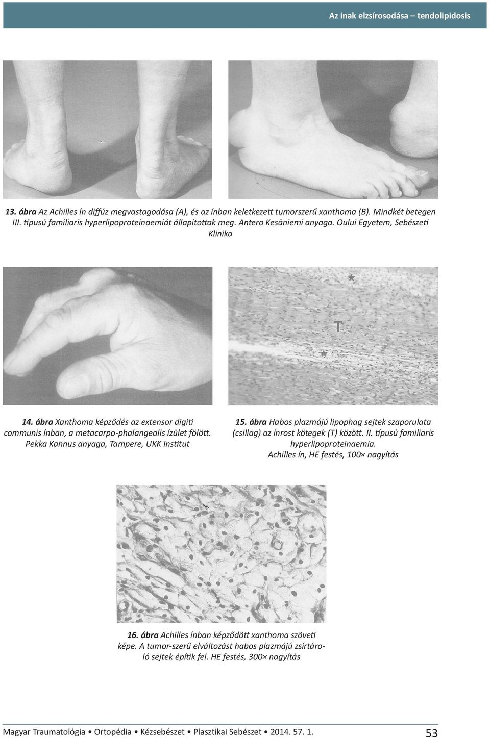 ábra Xanthoma képződés az extensor digiti communis ínban, a metacarpo-phalangealis ízület fölött. Pekka Kannus anyaga, Tampere, UKK Institut 15.