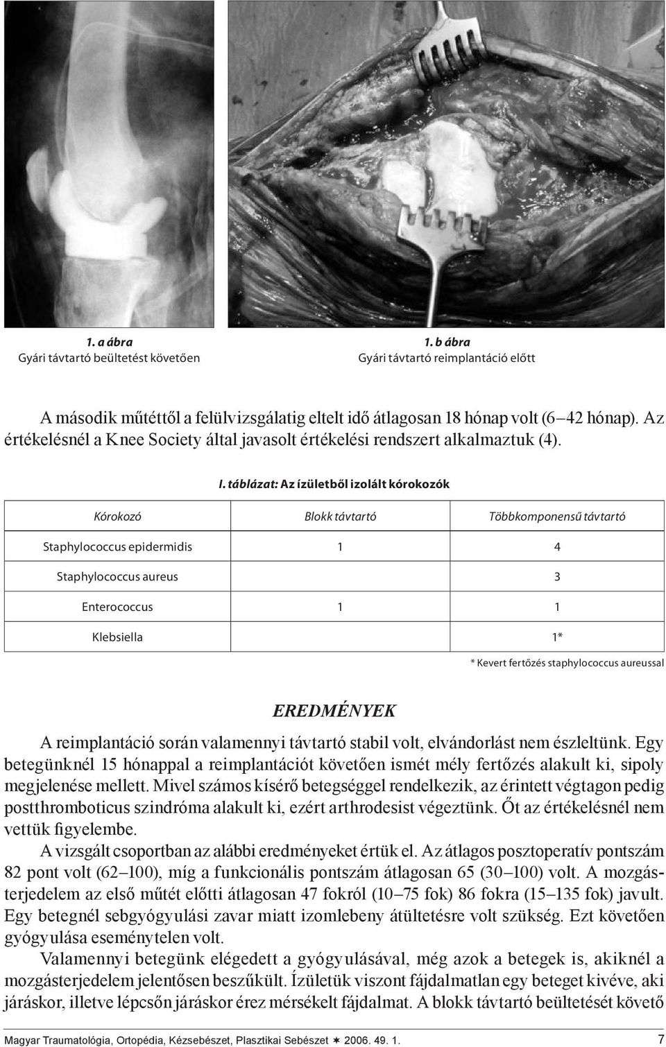 táblázat: Az ízületből izolált kórokozók Kórokozó Blokk távtartó Többkomponensű távtartó Staphylococcus epidermidis 1 4 Staphylococcus aureus 3 Enterococcus 1 1 Klebsiella 1* * Kevert fertőzés