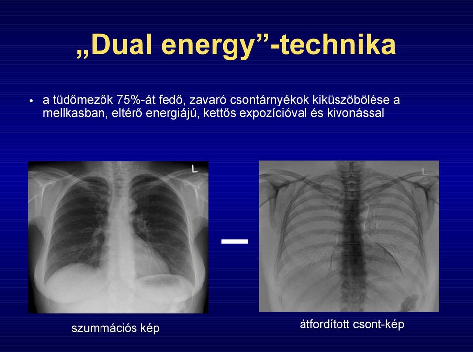 mellkasban, eltérő energiájú, kettős