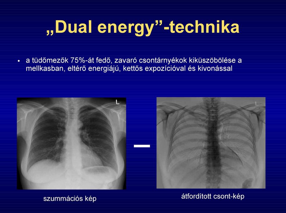 mellkasban, eltérő energiájú, kettős