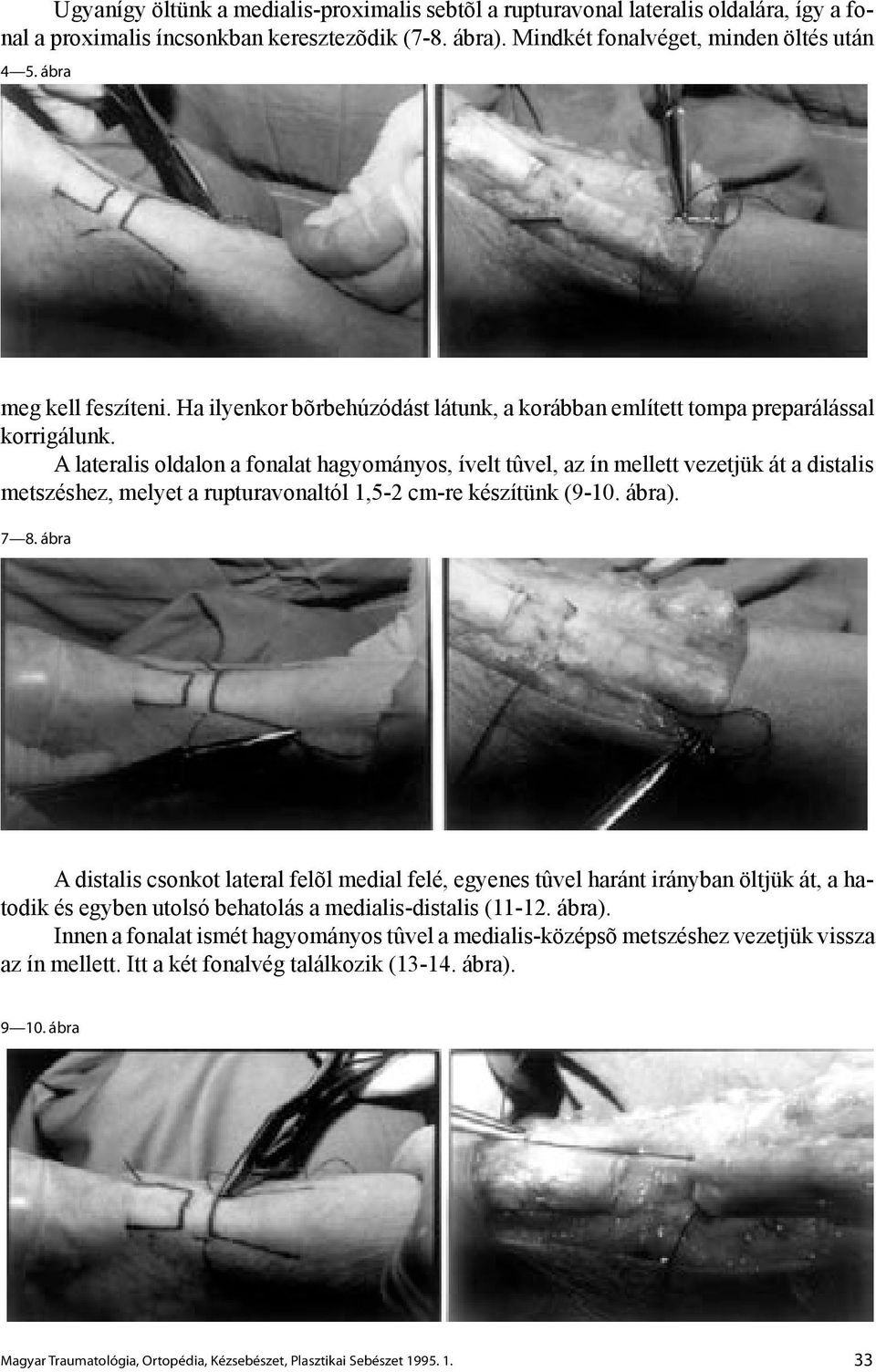 A lateralis oldalon a fonalat hagyományos, ívelt tûvel, az ín mellett vezetjük át a distalis metszéshez, melyet a rupturavonaltól 1,5-2 cm-re készítünk (9-10. ábra). 7 8.