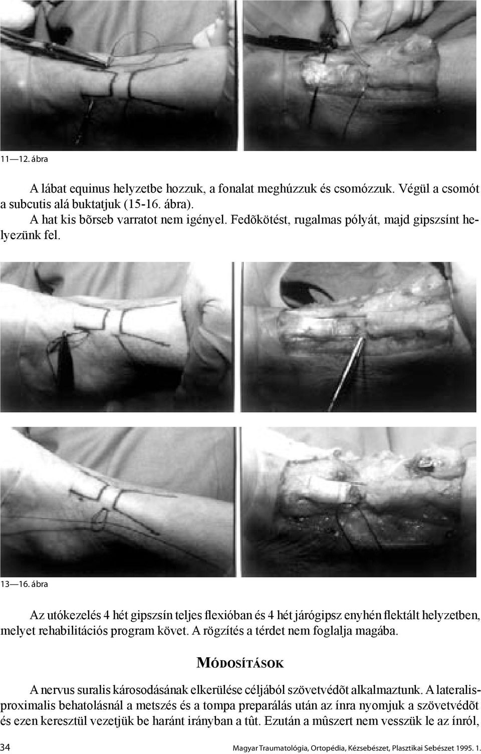 ábra Az utókezelés 4 hét gipszsín teljes flexióban és 4 hét járógipsz enyhén flektált helyzetben, melyet rehabilitációs program követ. A rögzítés a térdet nem foglalja magába.