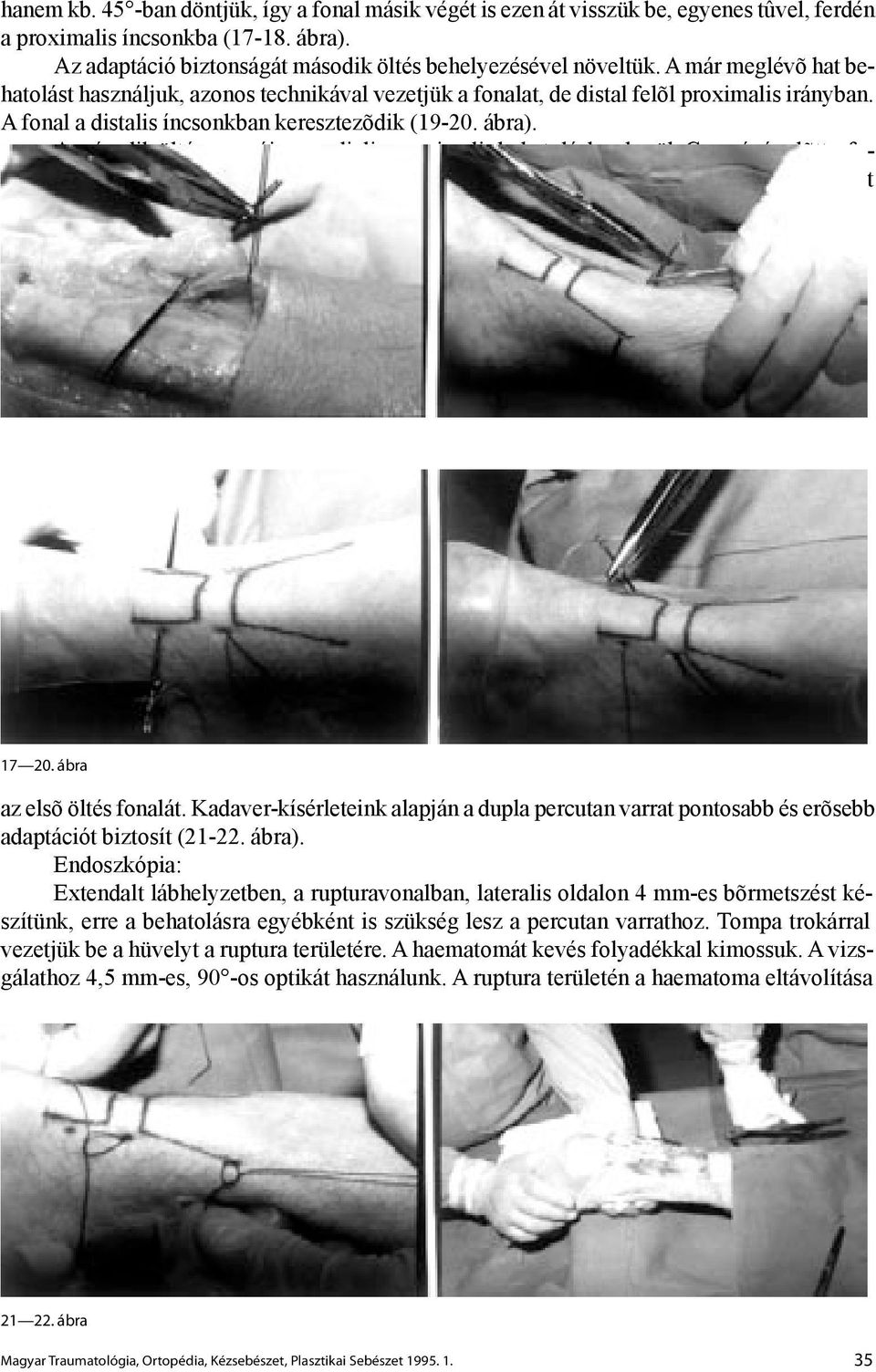 A második öltés csomója a medialis-proximalis behatoláshoz kerül. Csomózás elõtt a fonalak megfeszítésével kell meggyõzõdni arról, hogy a második öltés közben nem szúrtuk-e át 17 20.