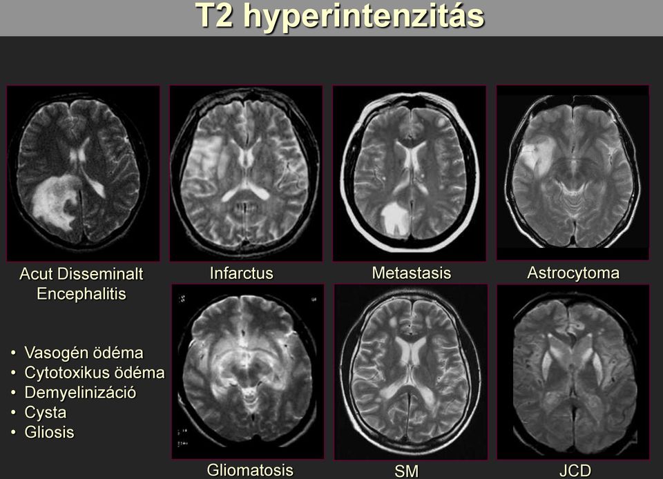 Astrocytoma Vasogén ödéma Cytotoxikus