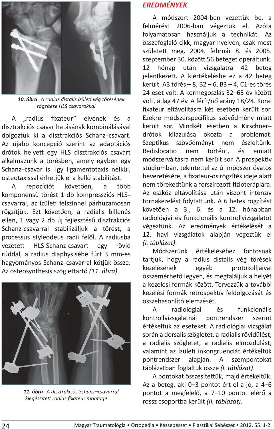 Így ligamentotaxis nélkül, osteotaxissal érhetjük el a kellő stabilitást. A repozíciót követően, a több komponensű törést 1 db kompressziós HLS csavarral, az ízüle felszínnel párhuzamosan rögzítjük.