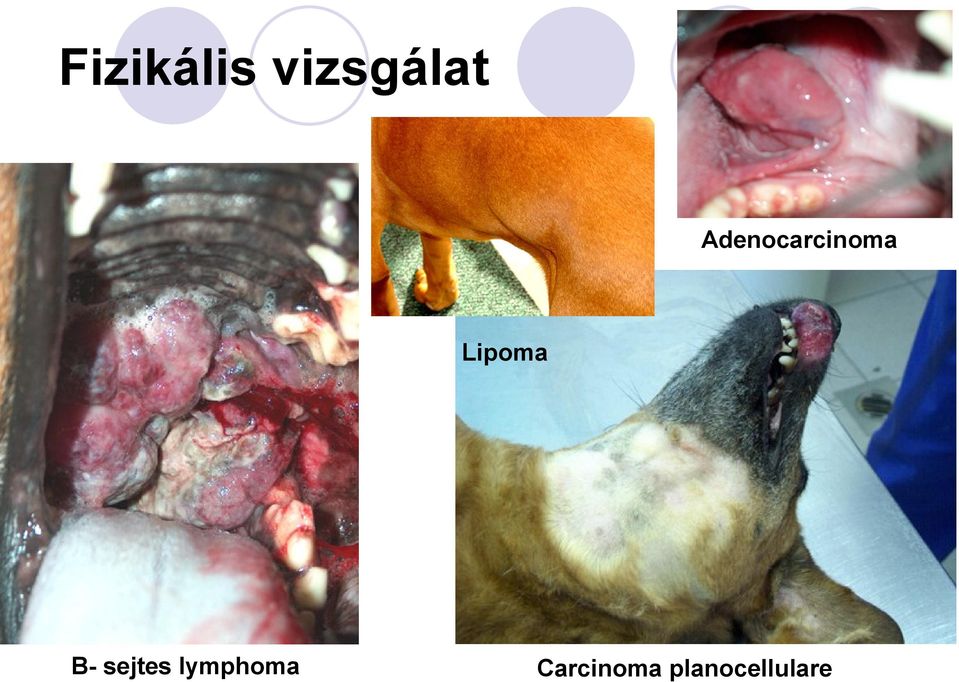 B- sejtes lymphoma