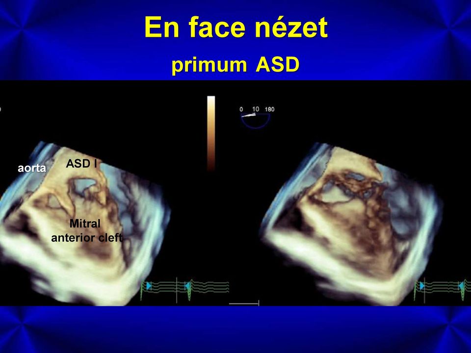 aorta ASD I
