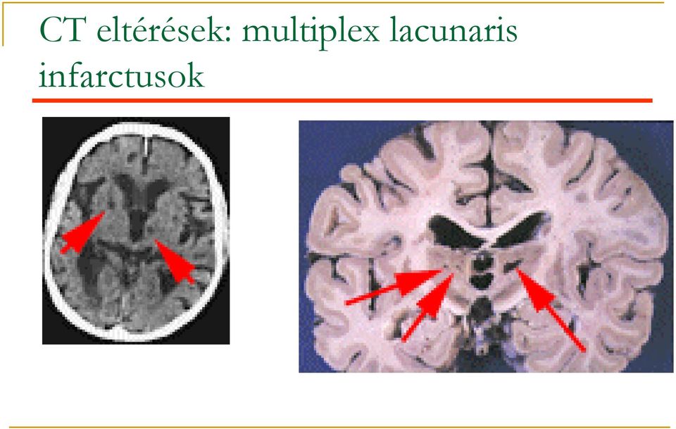 lacunaris