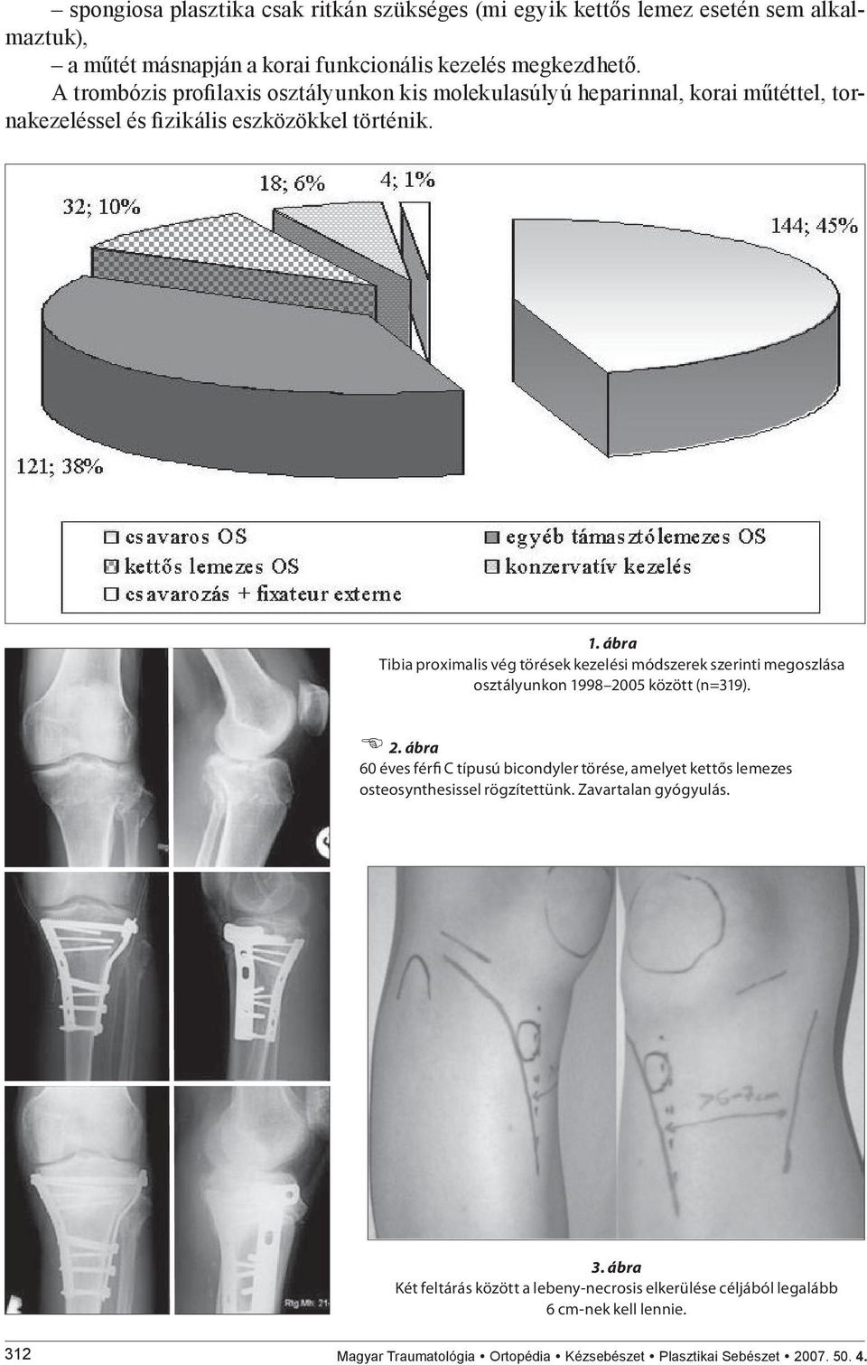 ábra Tibia proximalis vég törések kezelési módszerek szerinti megoszlása osztályunkon 1998 20