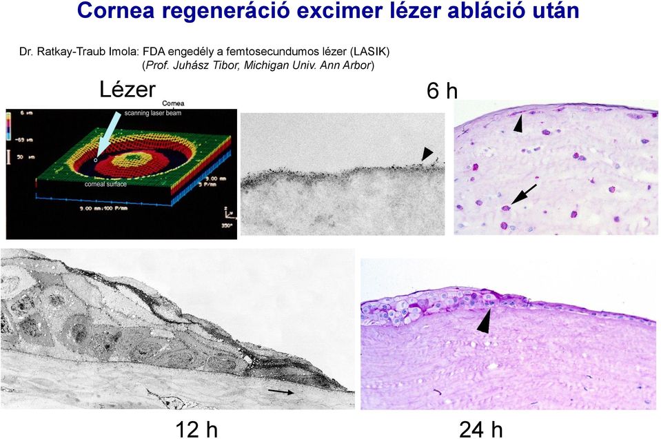 femtosecundumos lézer (LASIK) (Prof.