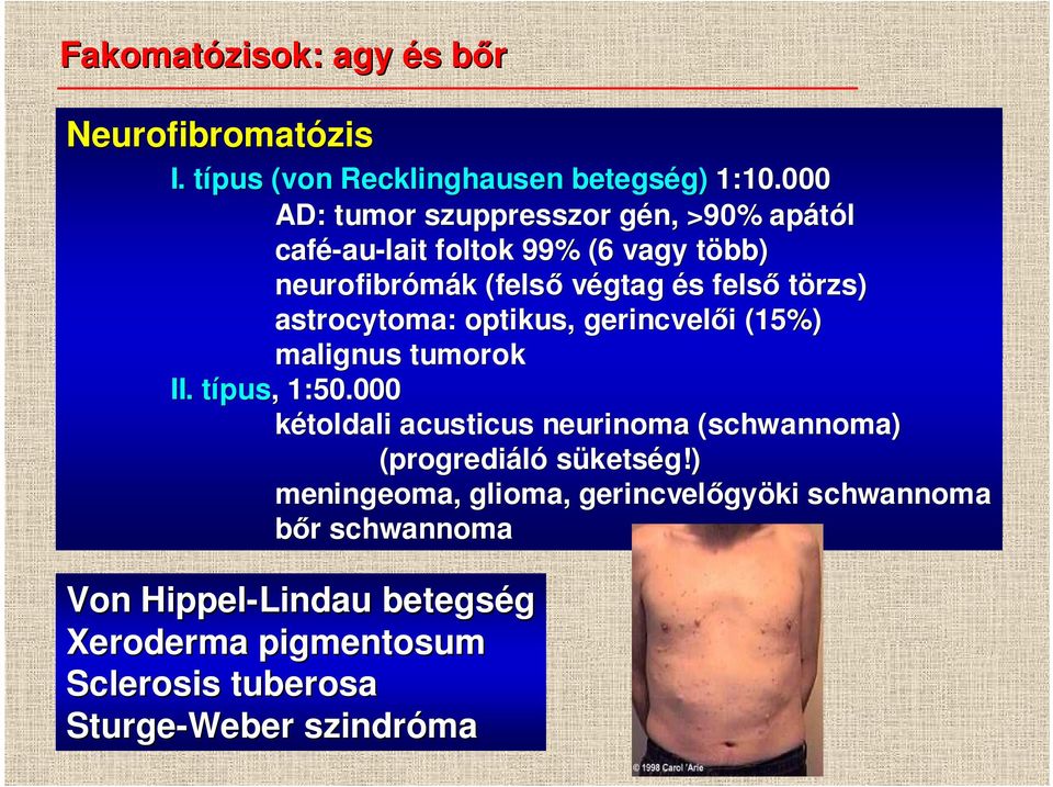 astrocytoma: : optikus, gerincvelıi i (15%) malignus tumorok II. típust pus, 1:50.