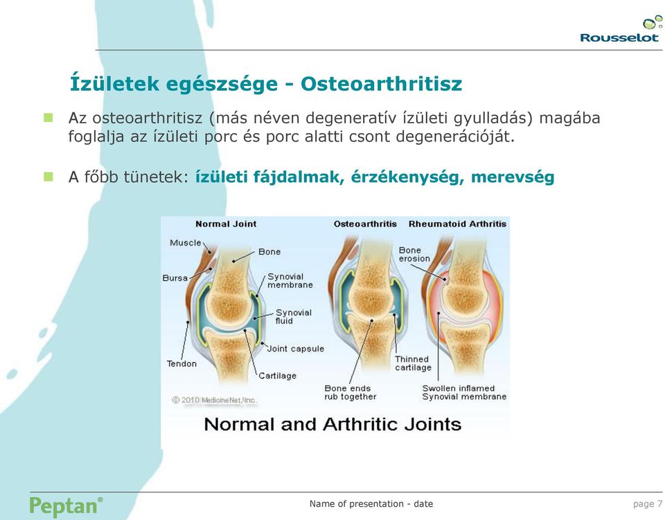 az ízületi porc és porc alatti csont degenerációját.