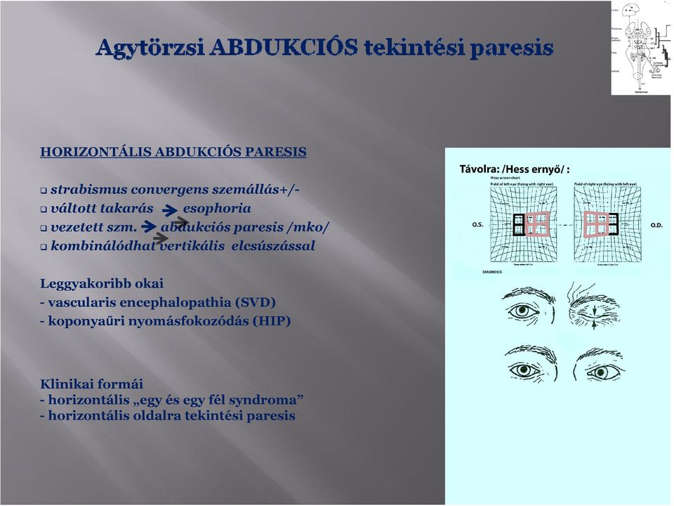 abdukciós paresis /mko/ kombinálódhat vertikális elcsúszással Leggyakoribb okai -