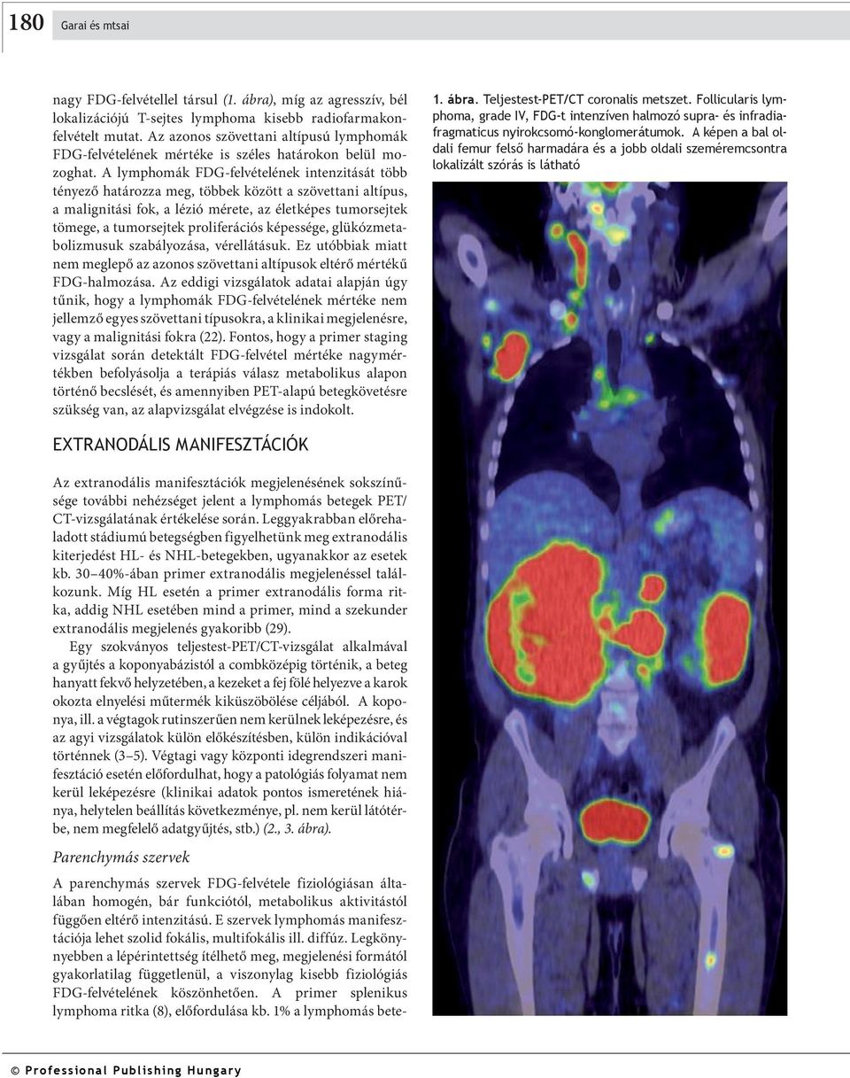 A lymphomák FDG-felvételének intenzitását tö tényező htározz meg, töek között szövettni ltípus, mlignitási fok, lézió mérete, z életképes tumorsejtek tömege, tumorsejtek proliferációs képessége,