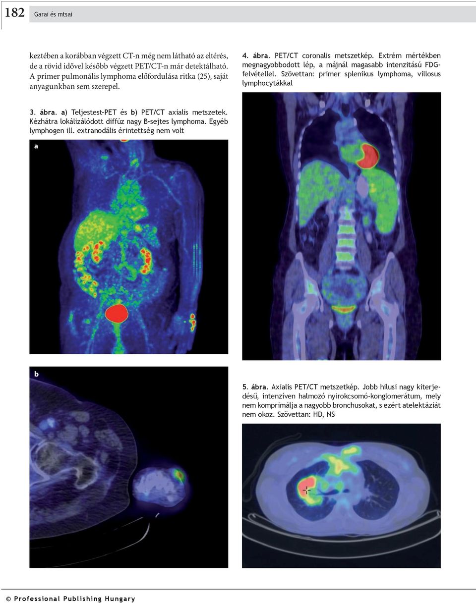 Szövettn: primer splenikus lymphom, villosus lymphocytákkl 3. ár. ) Teljestest-PET és ) PET/CT xilis metszetek. Kéz hát r lokálizálódott diffúz ngy B-sejtes lymphom. Egyé lym pho gen ill.