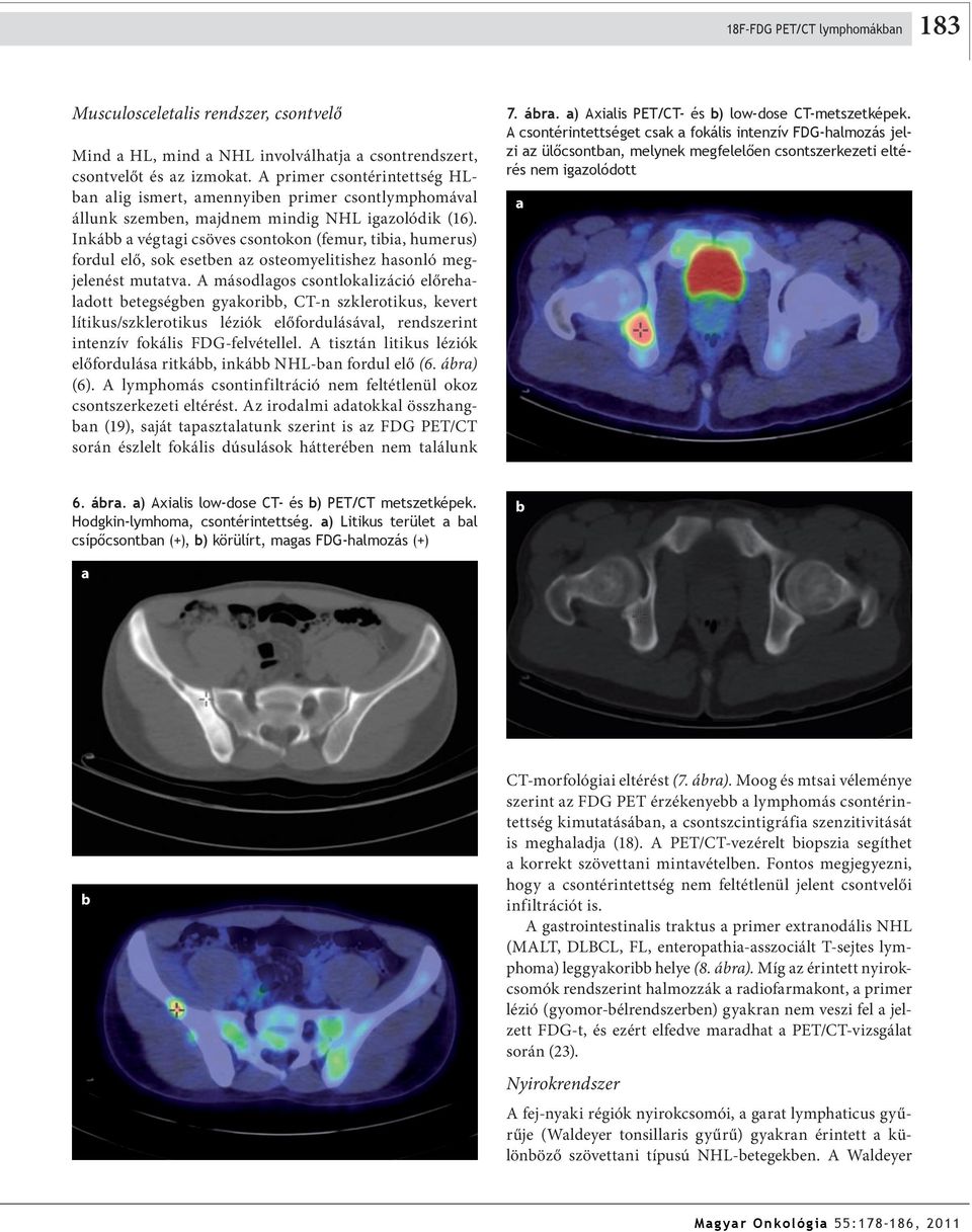 Inká végtgi csöves csontokon (femur, tii, humerus) fordul elő, sok eseten z osteomyelitishez hsonló megjelenést muttv.