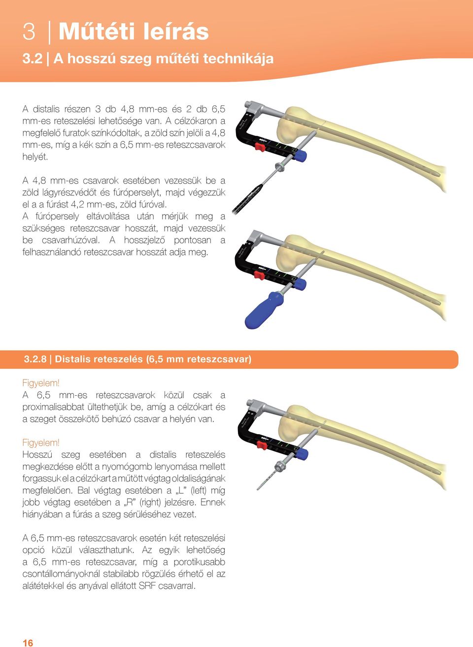 A 4,8 mm-es csavarok esetében vezessük be a zöld lágyrészvédőt és fúróperselyt, majd végezzük el a a fúrást 4,2 mm-es, zöld fúróval.