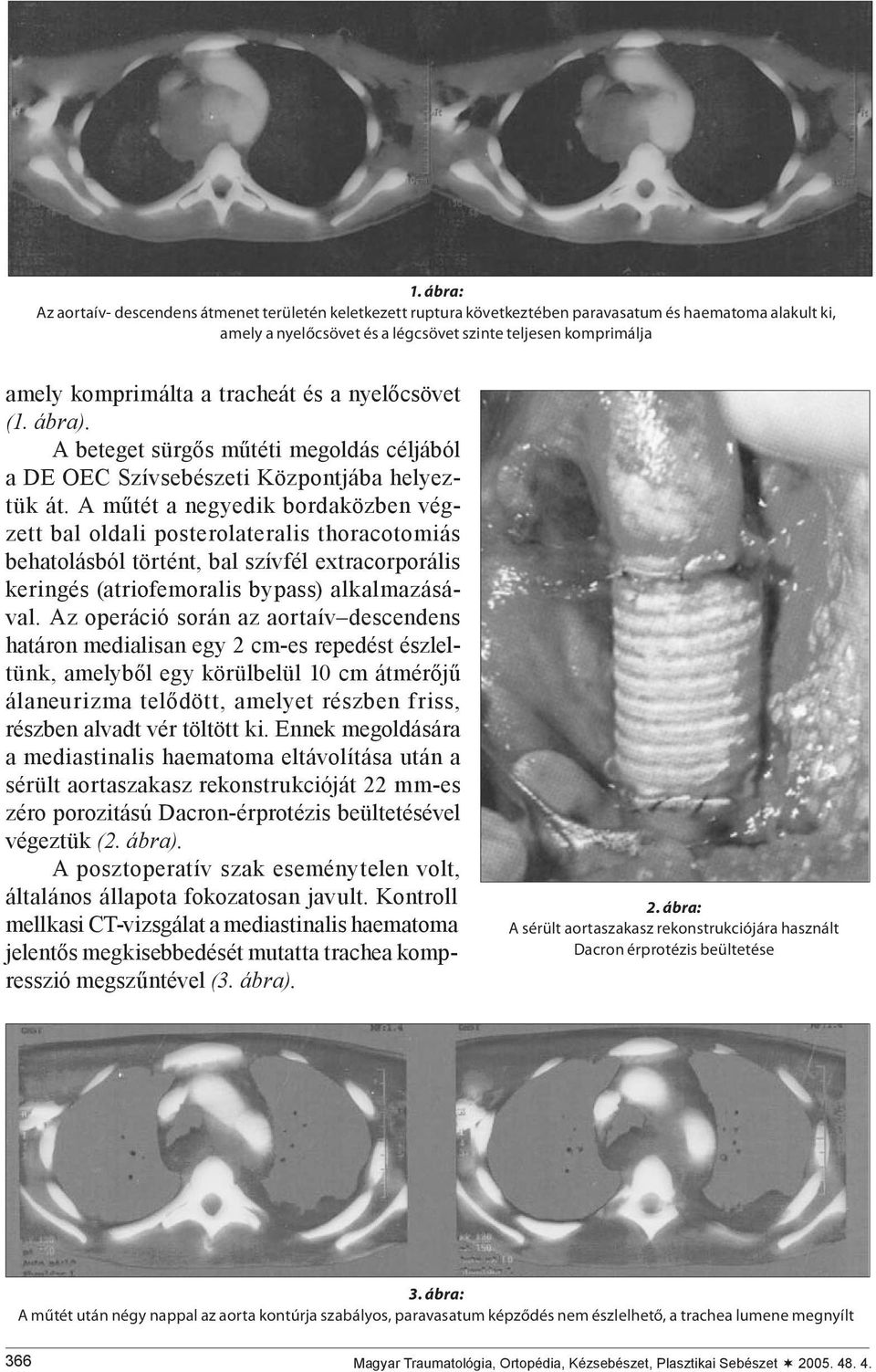 A műtét a negyedik bordaközben végzett bal oldali posterolateralis thoracotomiás behatolásból történt, bal szívfél extracorporális keringés (atriofemoralis bypass) alkalmazásával.