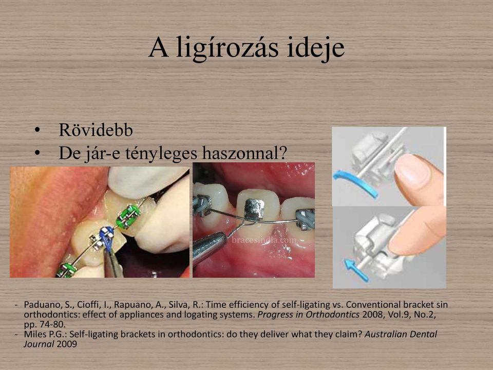Conventional bracket sin orthodontics: effect of appliances and logating systems.
