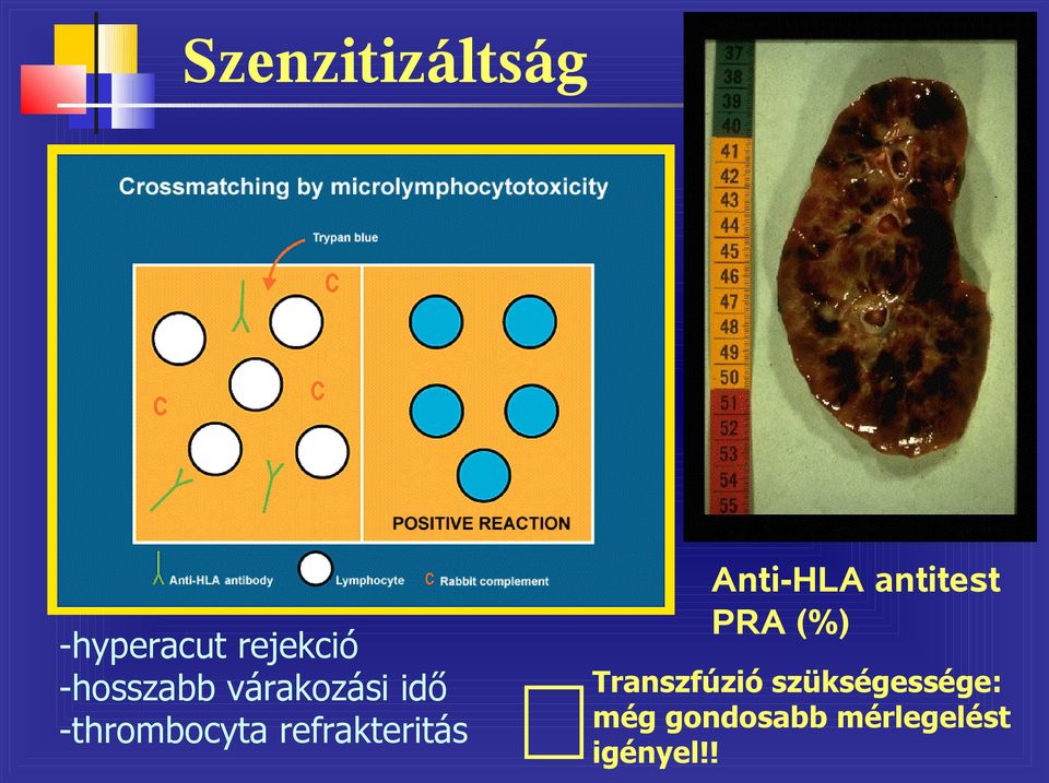 refrakteritás Anti-HLA antitest PRA (%)!