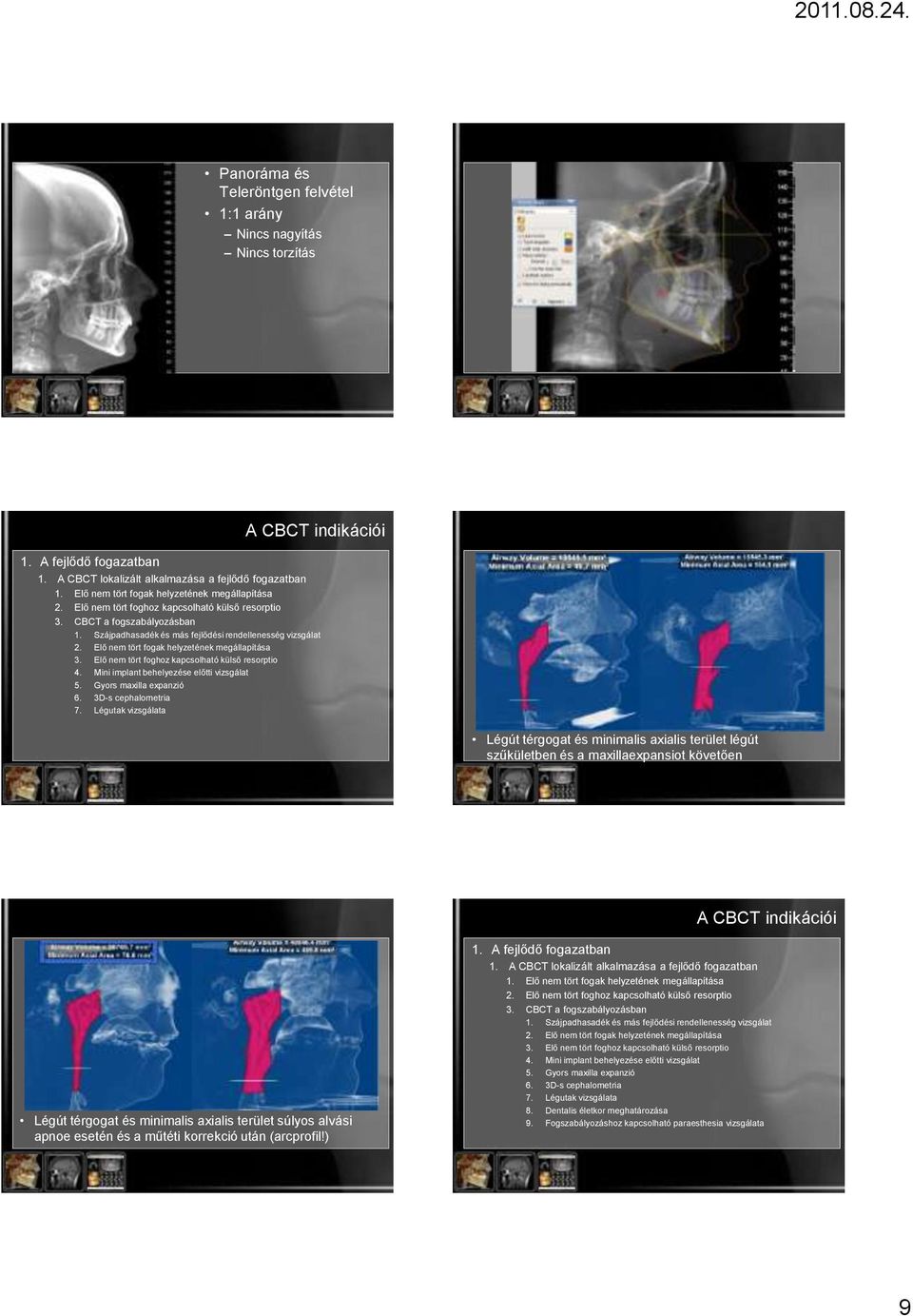 Elő nem tört foghoz kapcsolható külső resorptio 4. Mini implant behelyezése előtti vizsgálat 5. Gyors maxilla expanzió 6. 3D-s cephalometria 7.