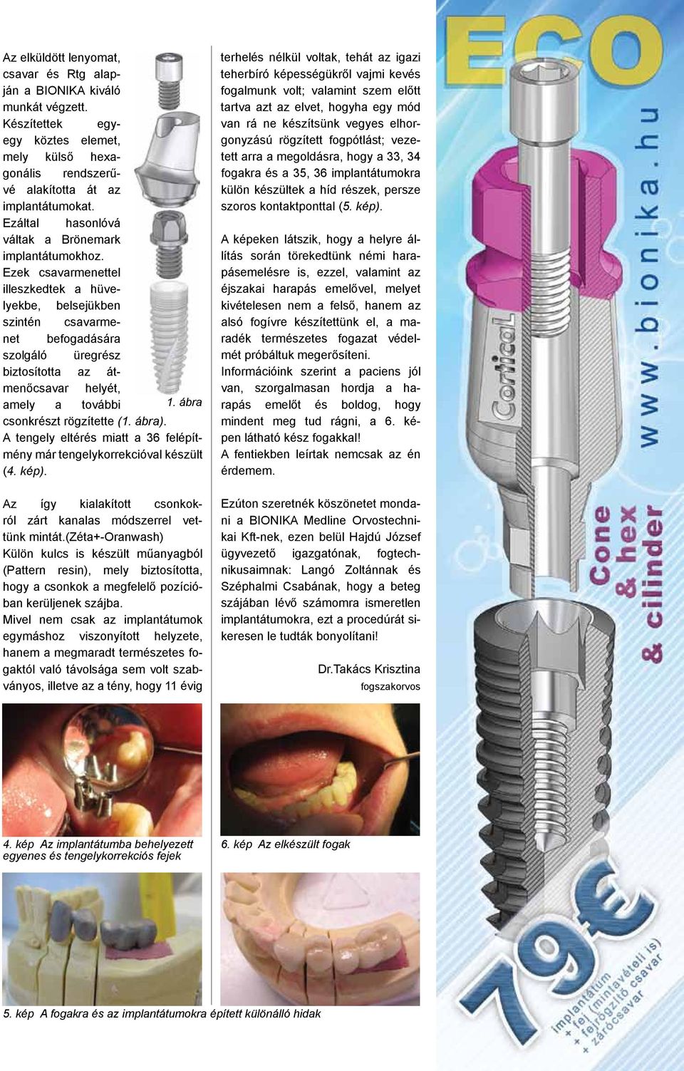 Ezek csavarmenettel illeszkedtek a hüvelyekbe, belsejükben szintén csavarmenet befogadására szolgáló üregrész biztosította az átmenőcsavar helyét, amely a további 1. ábra csonkrészt rögzítette (1.