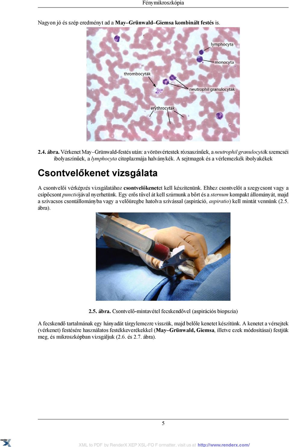 A sejtmagok és a vérlemezkék ibolyakékek Csontvelőkenet vizsgálata A csontvelői vérképzés vizsgálatához csontvelőkenetet kell készítenünk.