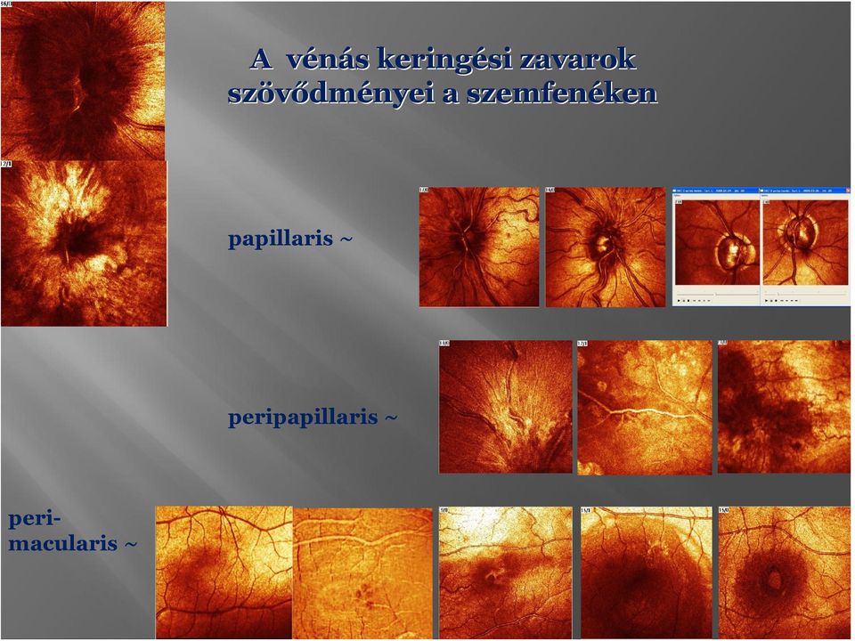 szemfenéken papillaris ~