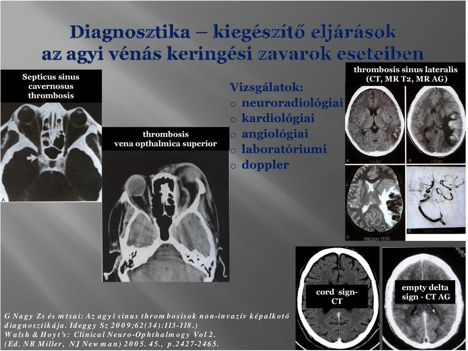 CT AG G Nagy Zs és mtsai: Az agyi sinus thrmbsisk nn-invazív képalktó diagnsztikája.