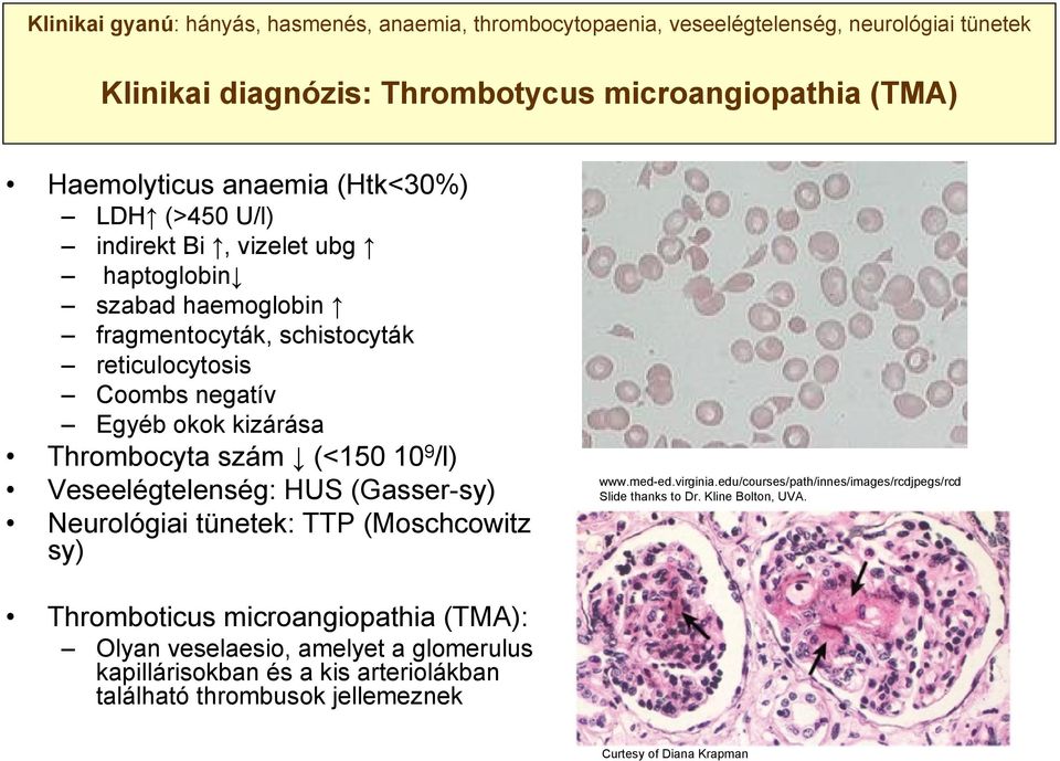 (<150 10 9 /l) Veseelégtelenség: HUS (Gasser-sy) Neurológiai tünetek: TTP (Moschcowitz sy) www.med-ed.virginia.edu/courses/path/innes/images/rcdjpegs/rcd Slide thanks to Dr.