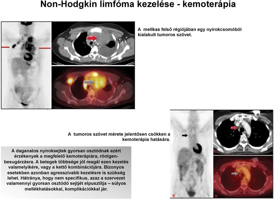 A daganatos nyiroksejtek gyorsan osztódnak ezért érzékenyek a megfelelő kemoterápiára, röntgenbesugárzásra.