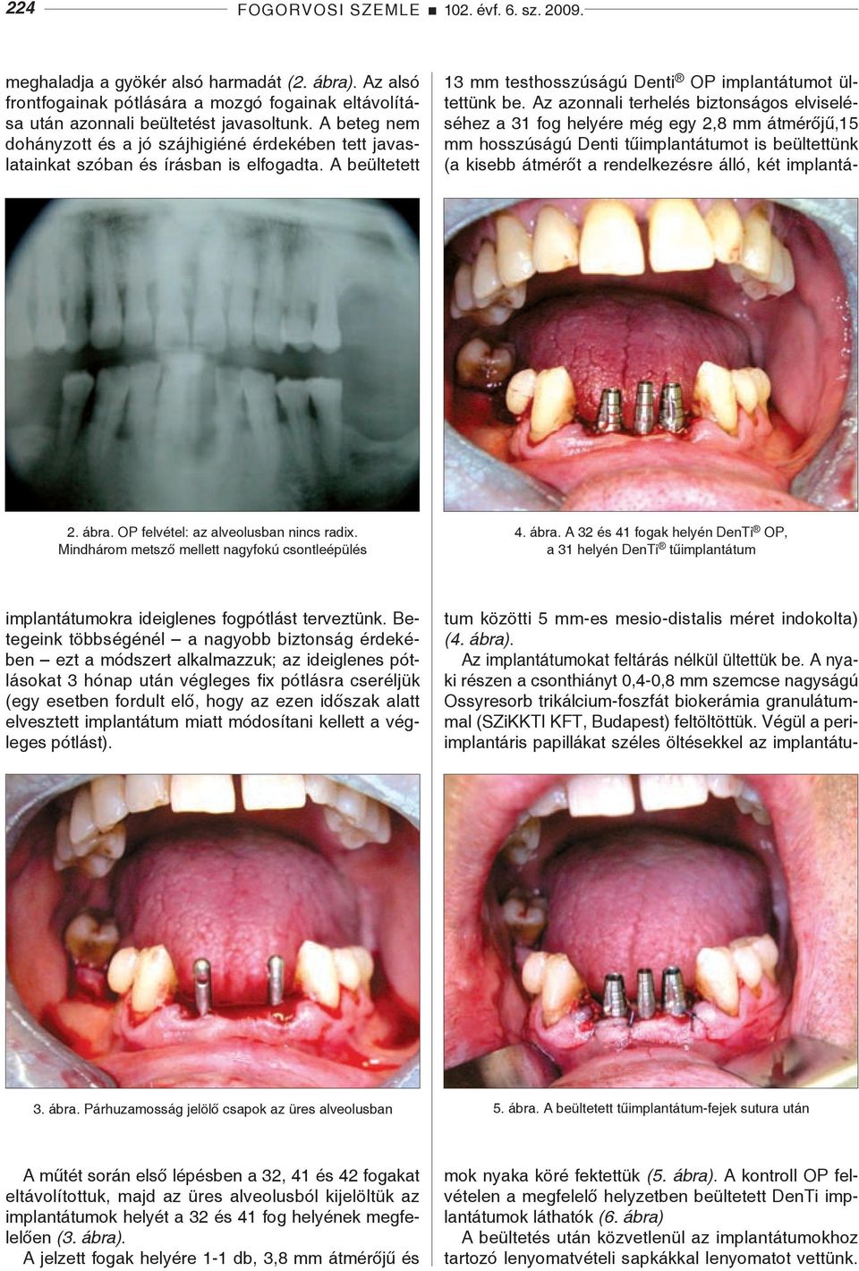 Mindhárom metsző mellett nagyfokú csontleépülés 4. ábra. A 32 és 41 fogak helyén DenTi OP, a 31 helyén DenTi tűimplantátum implantátumokra ideiglenes fogpótlást terveztünk.