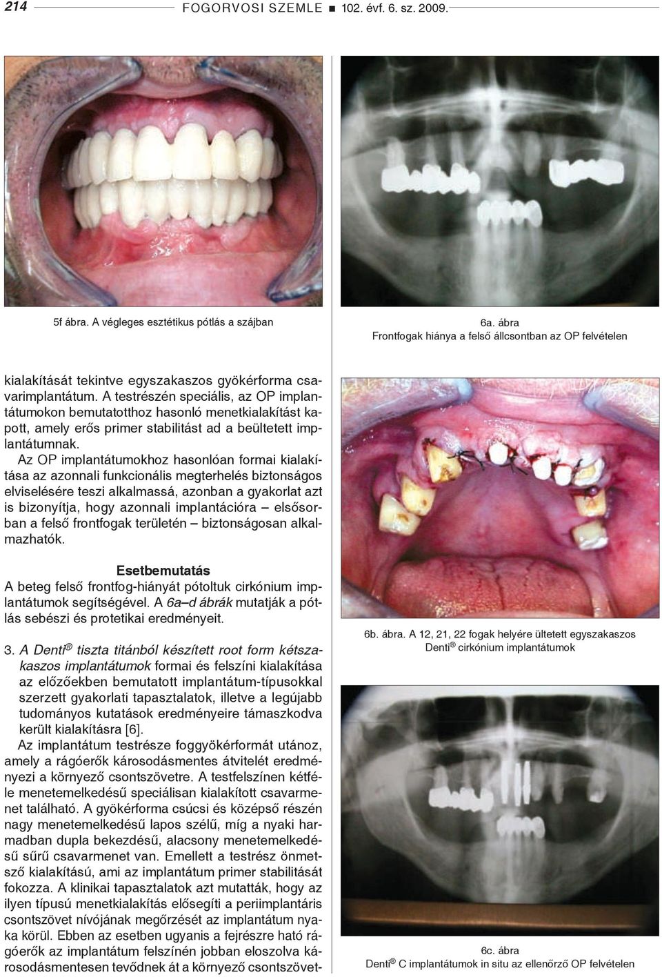 A testrészén speciális, az OP implantátumokon bemutatotthoz hasonló menetkialakítást kapott, amely erős primer stabilitást ad a beültetett implantátumnak.