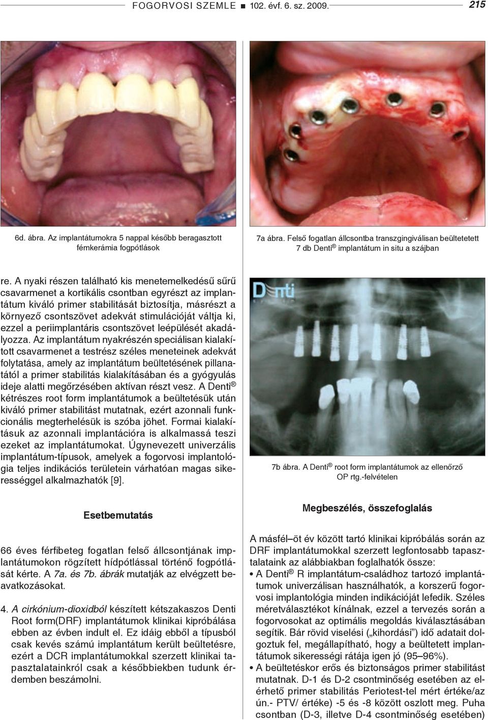 A nyaki részen található kis menetemelkedésű sűrű csavarmenet a kortikális csontban egyrészt az implantátum kiváló primer stabilitását biztosítja, másrészt a környező csontszövet adekvát