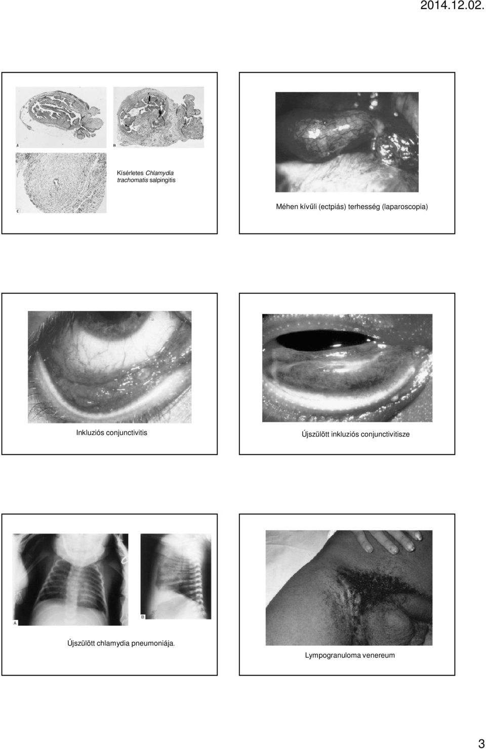 conjunctivitis Újszülött inkluziós conjunctivitisze