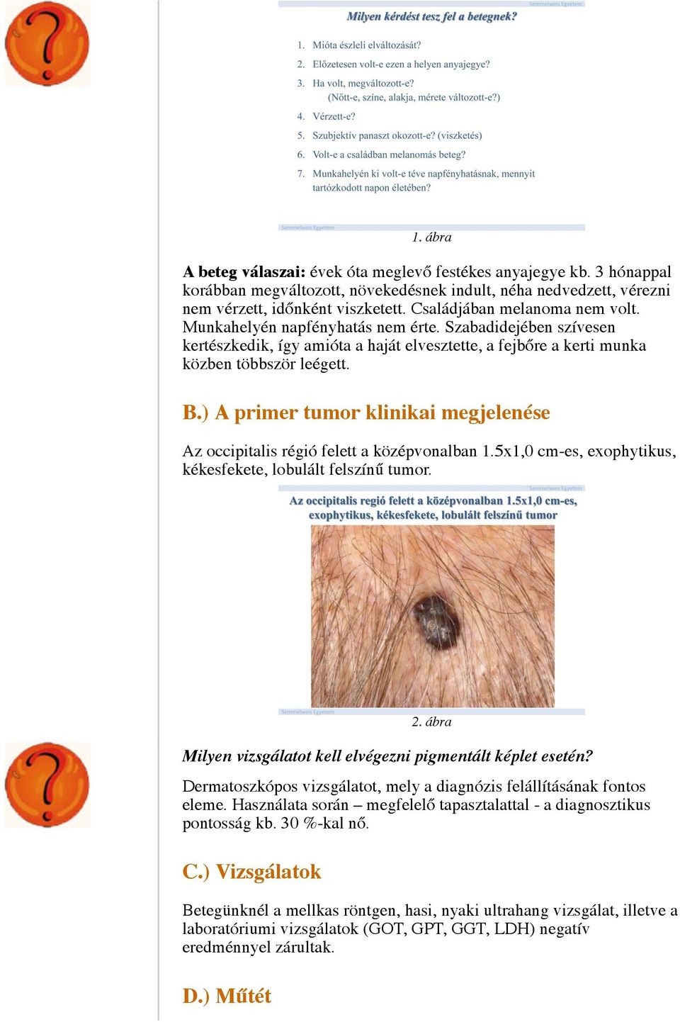 A melanoma malignum kezelése
