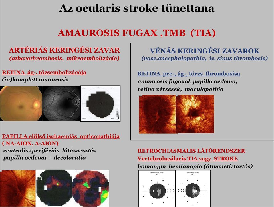 sinus thrmbsis) RETINA ág-, tözsemblizácója (in)kmplett amaursis RETINA pre-, ág-, törzs thrmbsisa amaursis fugaxk papilla edema,