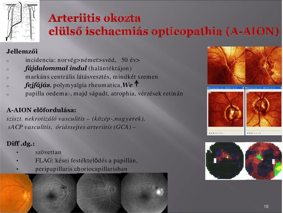 vérzések retinán A-AION előfrdulása: sziszt.