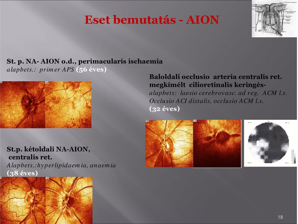 megkímélt ciliretinalis keringésalapbets: laesi cerebrvasc. ad reg. ACM l.s. Occlusi ACI distalis, cclusi ACM l.