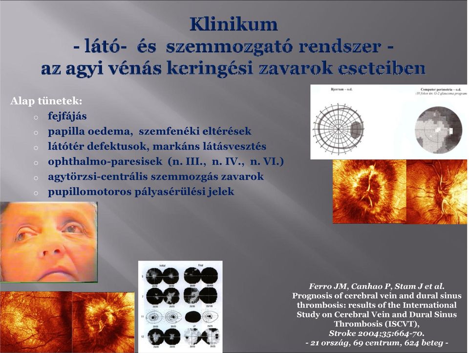 ) agytörzsi-centrális szemmzgás zavark pupillmtrs pályasérülési jelek Ferr JM, Canha P, Stam J et al.