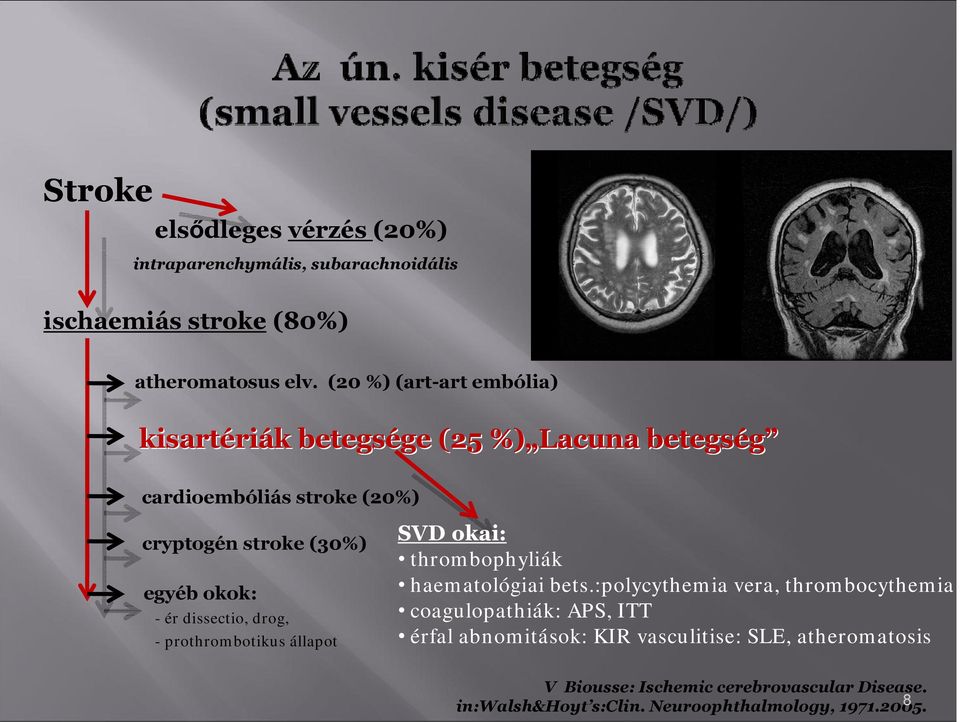 kk: - ér dissecti, drg, - prthrmbtikus állapt SVD kai: thrmbphyliák haematlógiai bets.